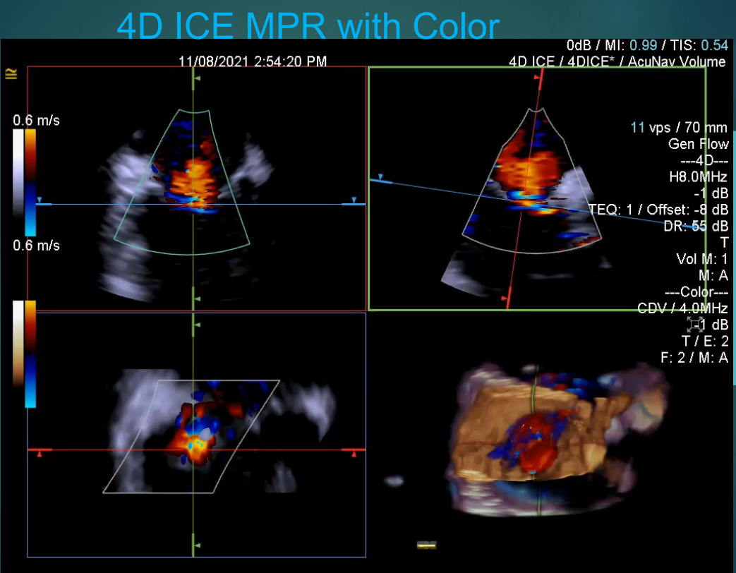 術(shù)中超聲成像新技術(shù)|心腔內(nèi)超聲（ICE）②市場研發(fā)篇